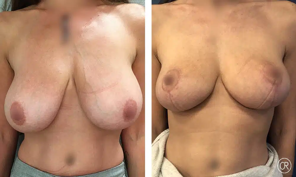 Photo de poitrine d une femme avant/apres ptose mammaire | Dr Christophe Reinbold Lyon