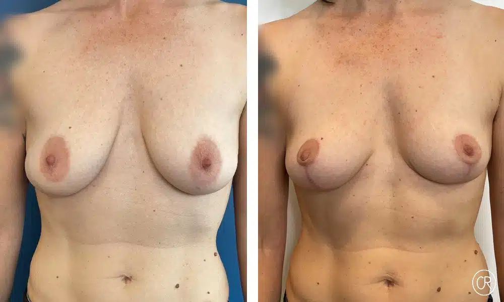 Poitrine d une femme avant/apres ptose mammaire | Dr Christophe Reinbold Lyon