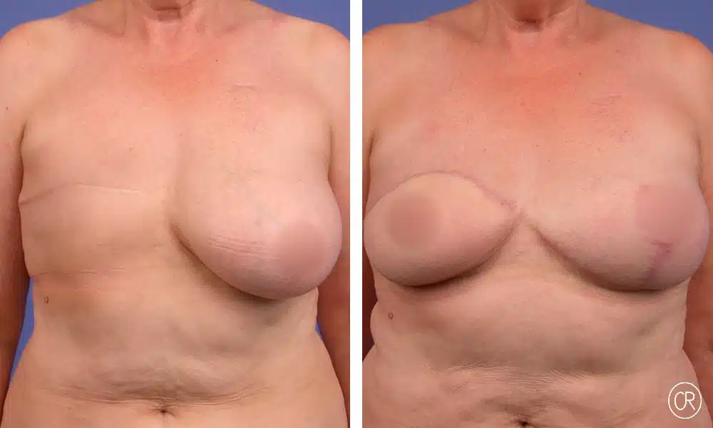 Poitrine d une femme avant/apres reconstruction mammaire | Dr Christophe Reinbold Lyon