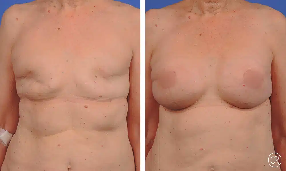 Photo de poitrine d une femme avant/apres reconstruction mammaire | Dr Christophe Reinbold Lyon