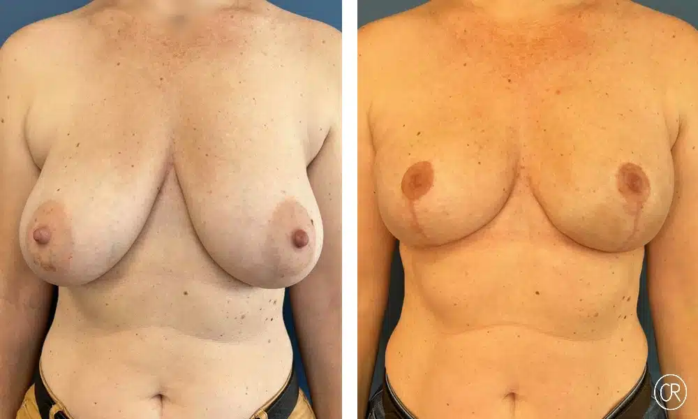 Photo de poitrine d une femme avant/apres reconstruction mammaire | Dr Christophe Reinbold Lyon