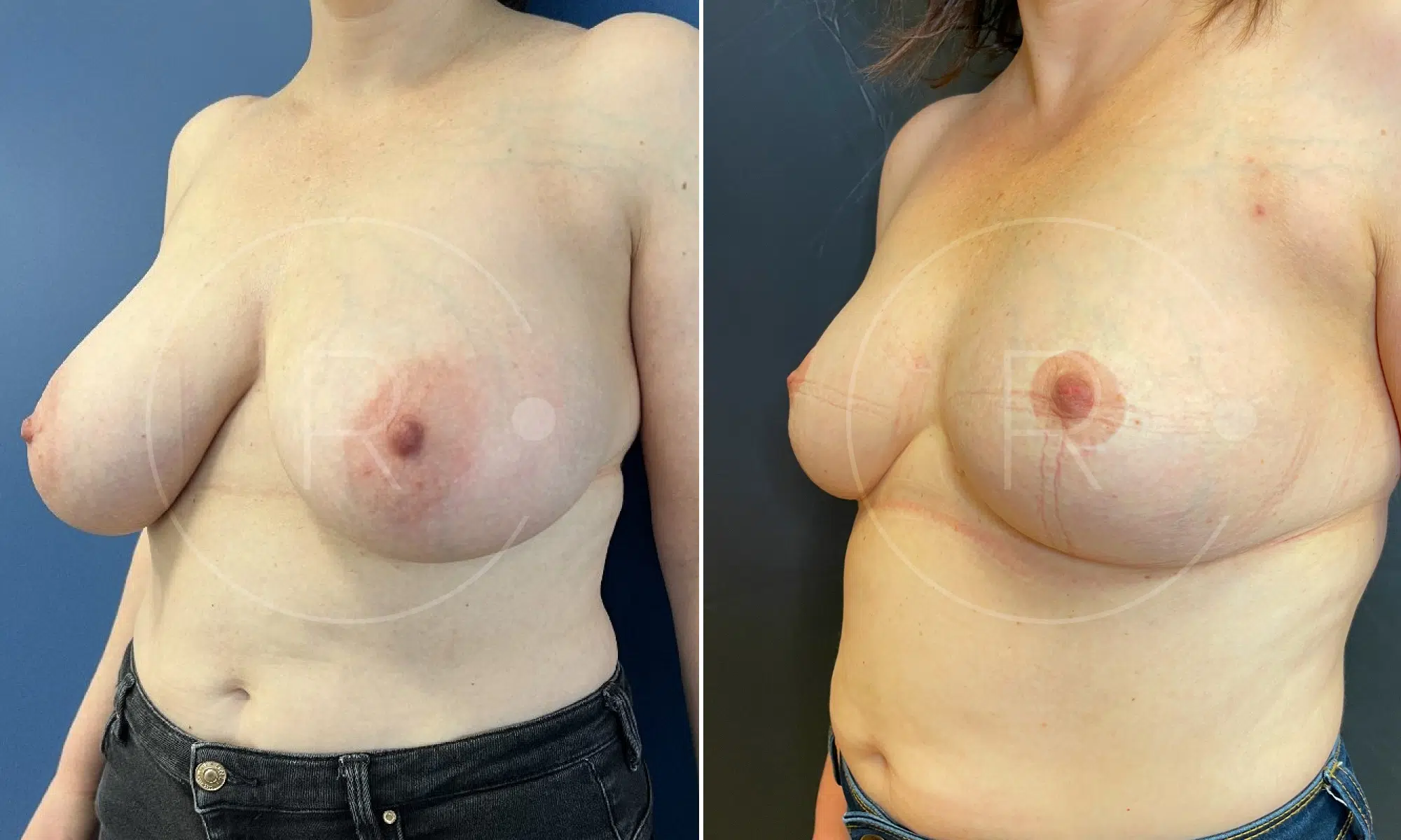 Photo de poitrine d une femme avant/apres reduction mammaire | Dr Christophe Reinbold Lyon