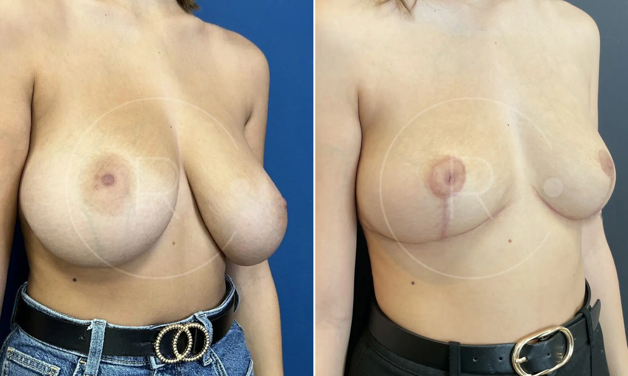 Poitrine d une femme avant/apres reduction mammaire | Dr Christophe Reinbold Lyon