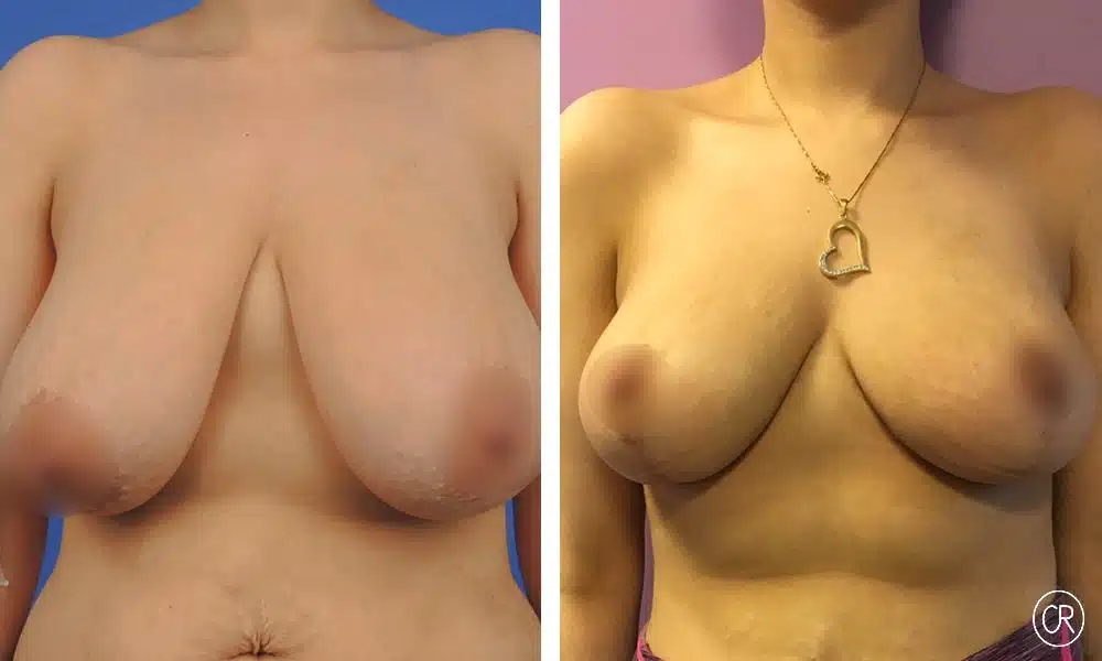 Photo de poitrine d une femme avant/apres reduction mammaire | Dr Christophe Reinbold Lyon