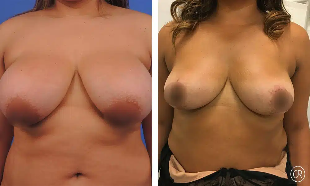 Poitrine d une femme avant/apres reduction mammaire | Dr Christophe Reinbold Lyon