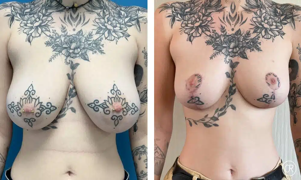 Poitrine tatouee d une jeune femme avant/apres reduction mammaire | Dr Christophe Reinbold Lyon