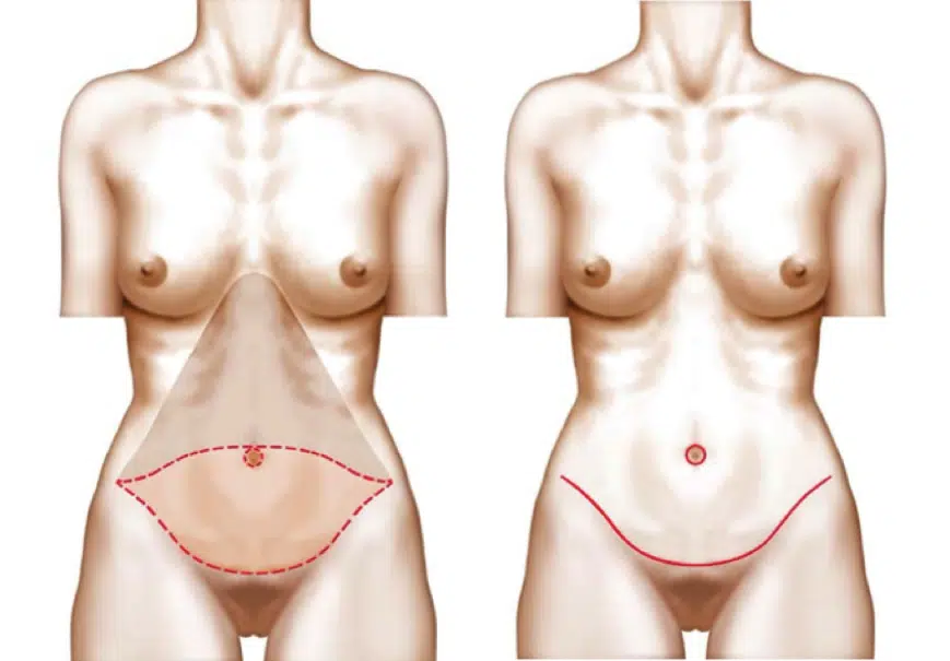 Dessin du corps d une femme de profile face montrant les zones traitee par plastie abdominale | Dr Christophe Reinbold Lyon