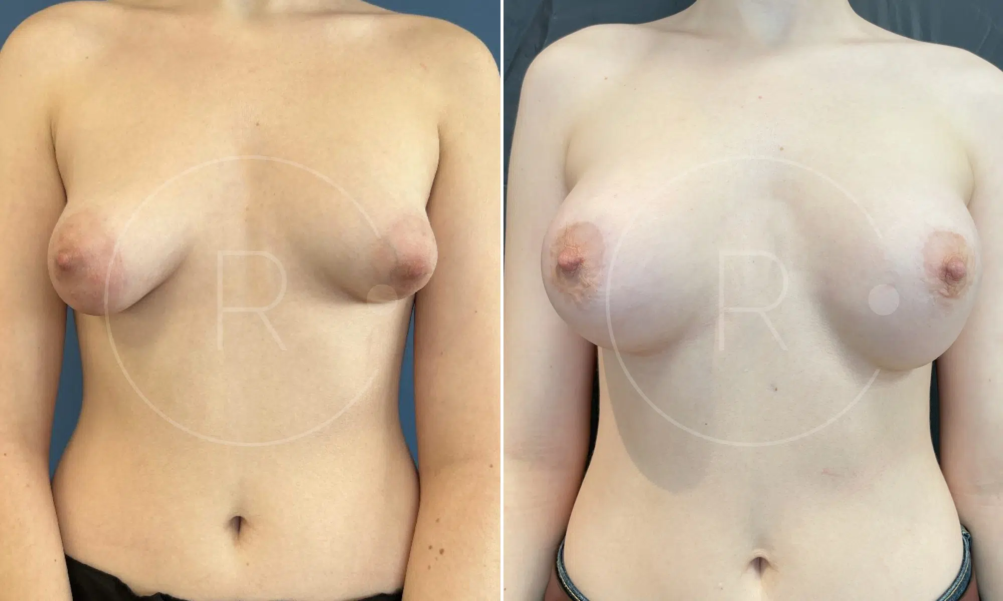 Poitrine d une femme avant/apres seins tubereux | Dr Christophe Reinbold Lyon