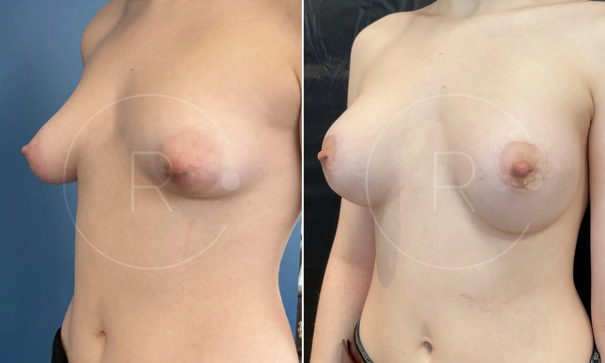 Photo de poitrine d une femme avant/apres seins tubereux | Dr Christophe Reinbold Lyon