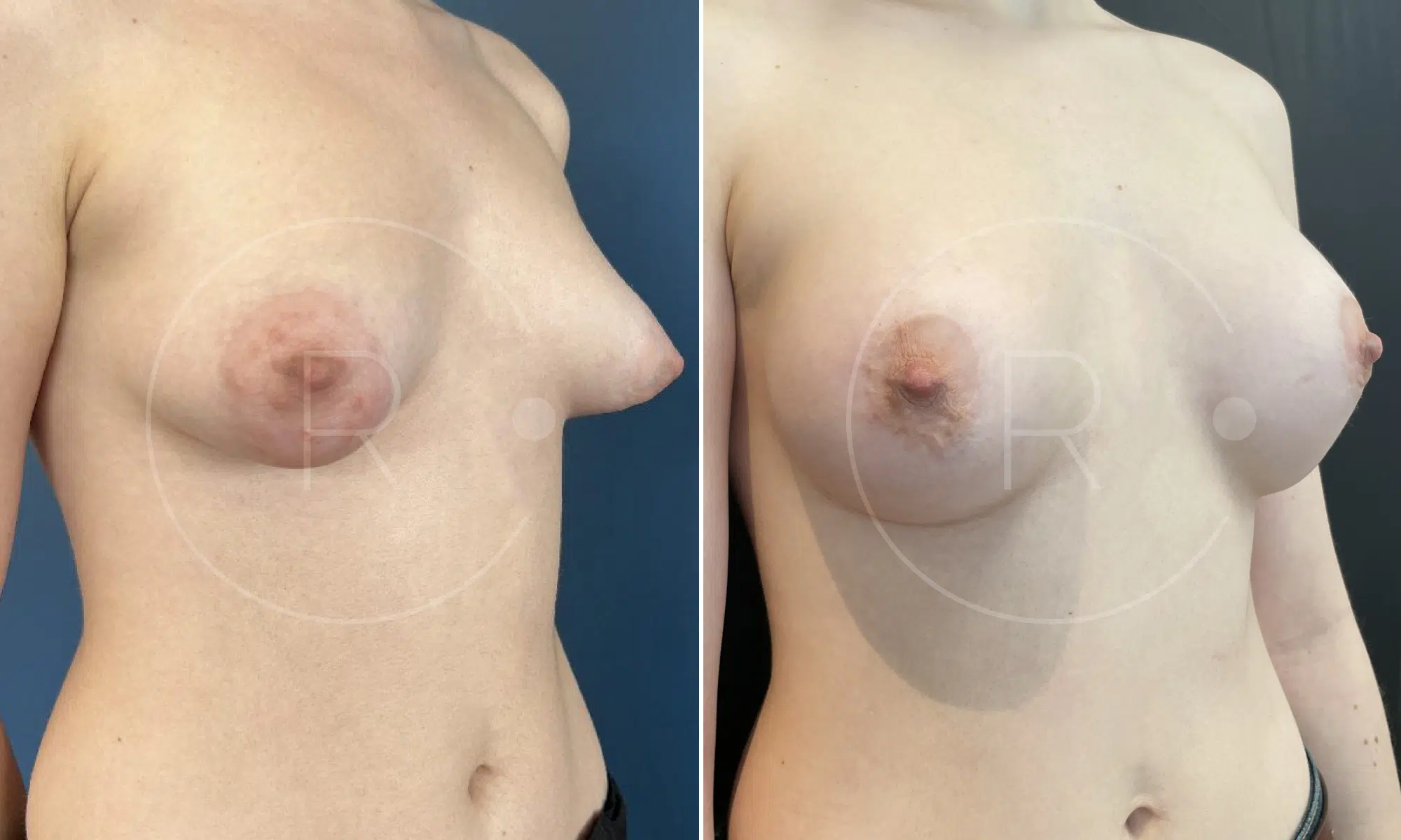 Poitrine d une femme avant/apres seins tubereux | Dr Christophe Reinbold Lyon