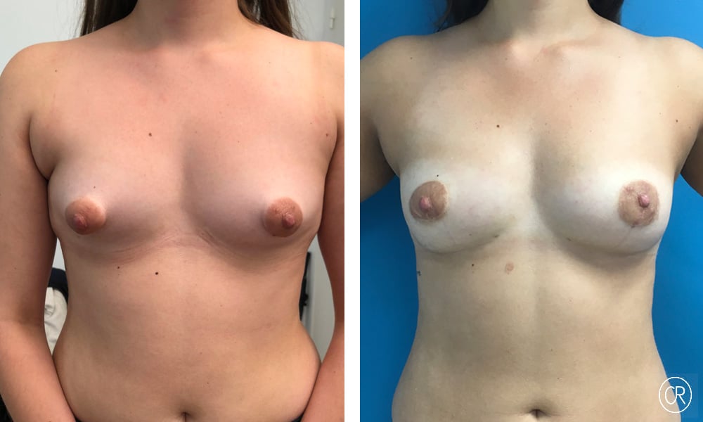 Photo de poitrine d une femme avant/apres seins tubereux | Dr Christophe Reinbold Lyon