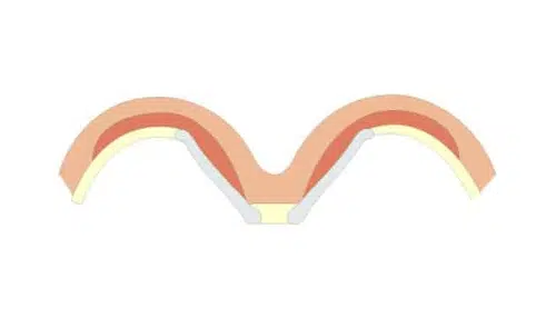 Dessin montrant les types de pectus excavatum classification de Chin type 1 | Dr Christophe Reinbold Lyon