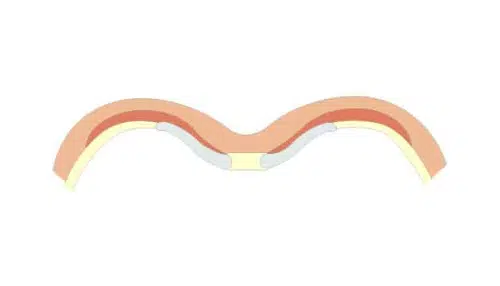 Dessin montrant les types de pectus excavatum classification de Chin type 2 | Dr Christophe Reinbold Lyon