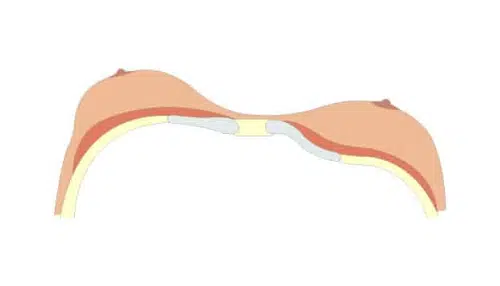 Illustration montrant les types de pectus excavatum classification de Chin type 3 | Dr Christophe Reinbold Lyon