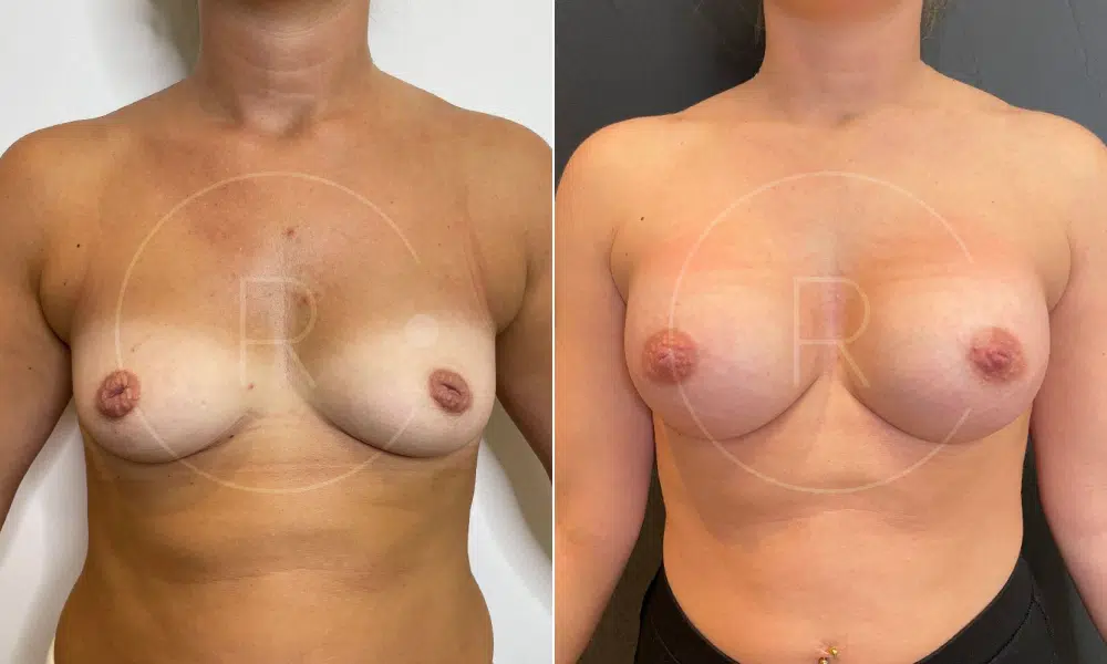 Avant et après d’une Augmentation mammaire avec cure de mamelons ombiliqués chez une femme adulte- Dr Reinbold | Lyon
