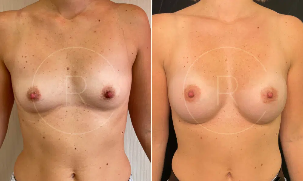 Photo Avant et après d’une femme - augmentation mammaire composite par prothése Implants MOTIVA 295 - Dr Reinbold | Lyon