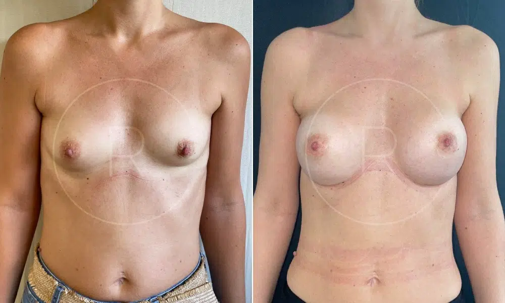 Photo avant et après d'une augmentation mammaire composite Implants MOTIVA 245, vue de face sur la poitrine nu - Dr Reinbold | Lyon