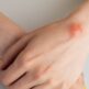 Qu’est-ce qu’un lipome et faut-il le retirer ?