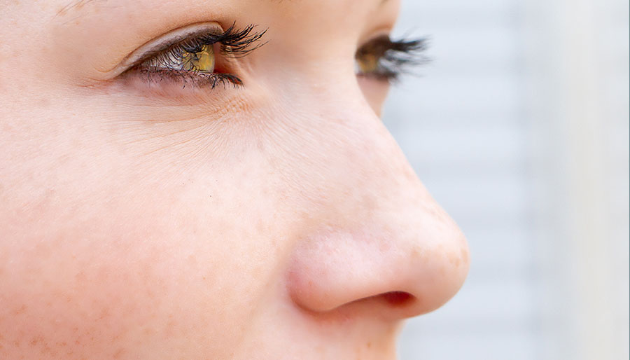 Corrigez votre nez avec la rhinoplastie médicale : les défauts traités sans chirurgie