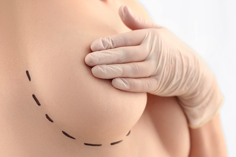 Reconstruction mammaire : une étape clé dans le traitement de votre cancer du sein